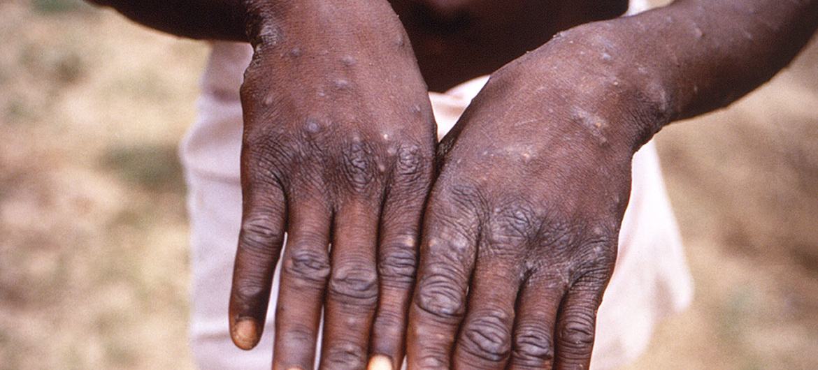CDC  |  شاب يظهر على يديه تفشي جدري القردة في جمهورية الكونغو الديمقراطية